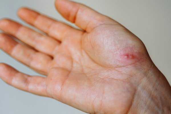 Comment soulager l'eczema des mains rapidement et efficacement